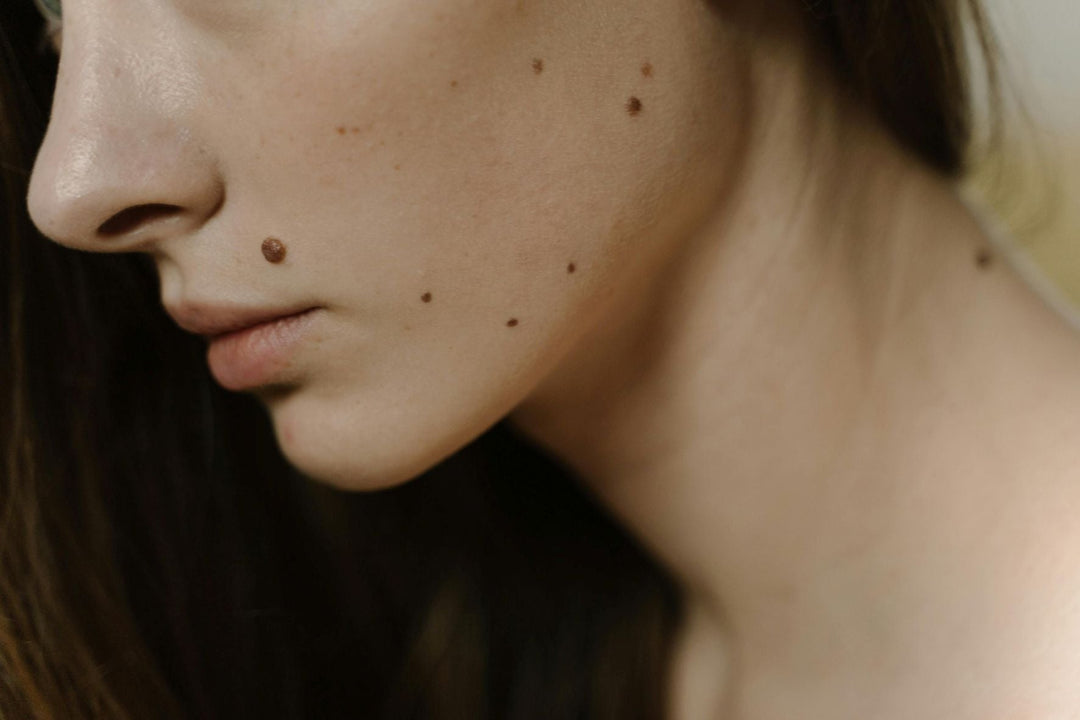 What to Do If You Have an Annoying Mole: Safe Removal and Care Options