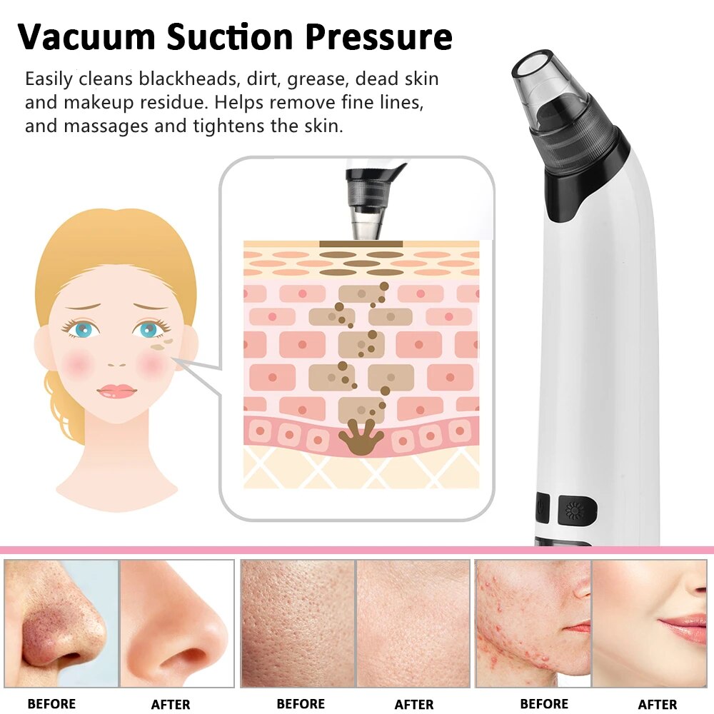 Multi-Functional Electric Blackhead Remover Vacuum with Customizable Suction & Interchangeable Heads