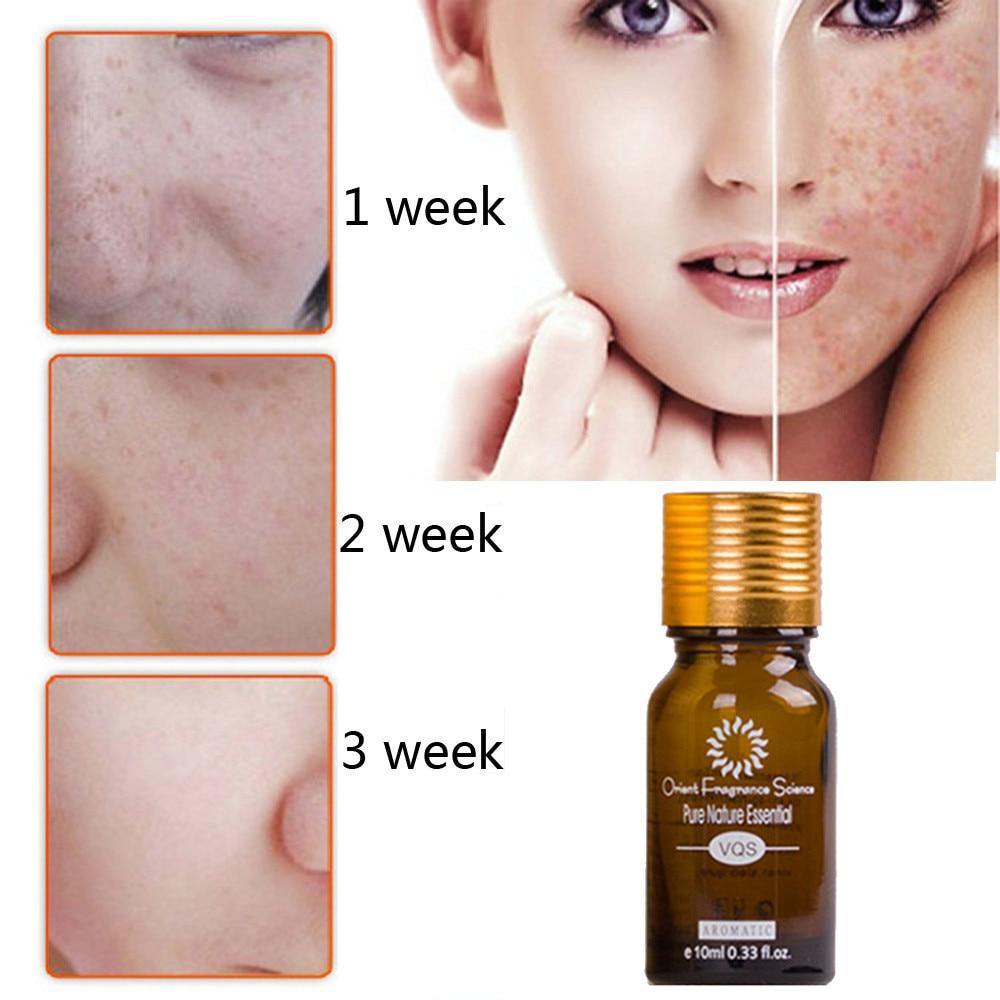 Dredge Meridian Skin Care Natural Pure Removal Acne Stretch Marks Scar Removal Essence oil - MRSLM