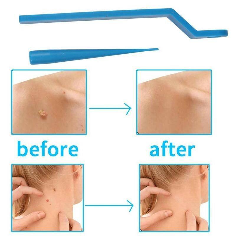 Skin Tag Kill Skin Mole Wart Remover Micro Band Skin Tag Removal Kit Adult Mole Wart Face Care - MRSLM